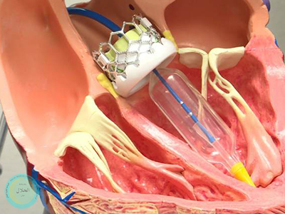 Aortic Aneurysm Surgery & Repair