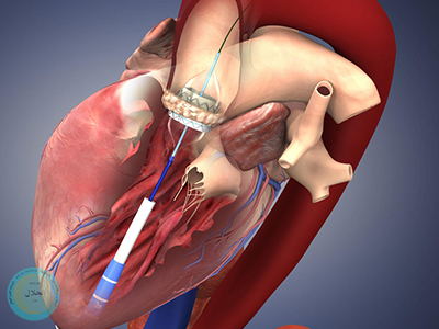 جراحی تعویض دریچه قلب